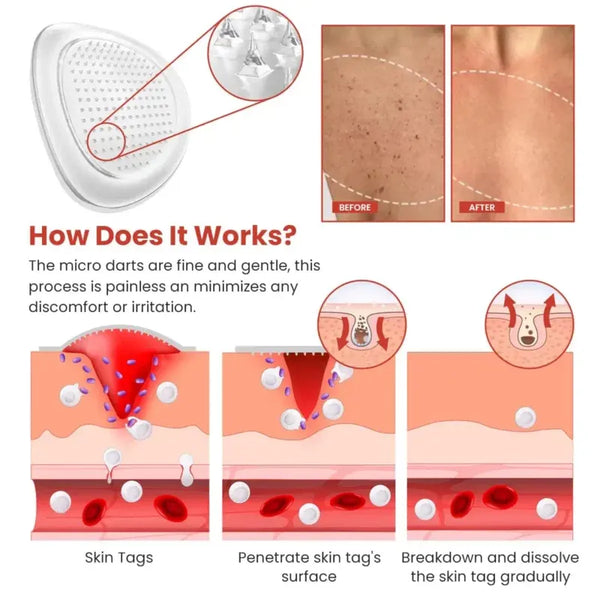 Derma Smooth Skin Tag Removal Patch